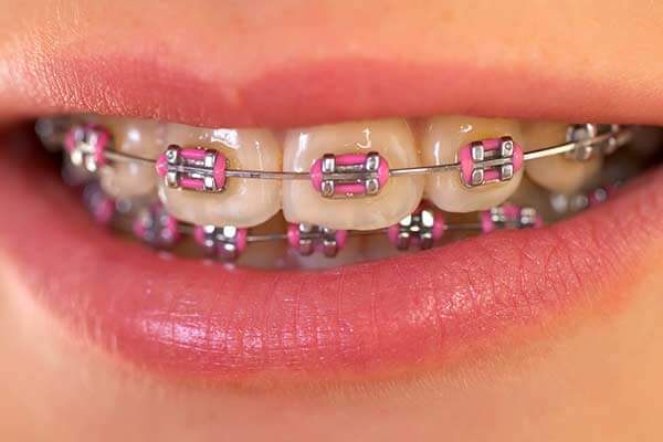 Metal Braces Image