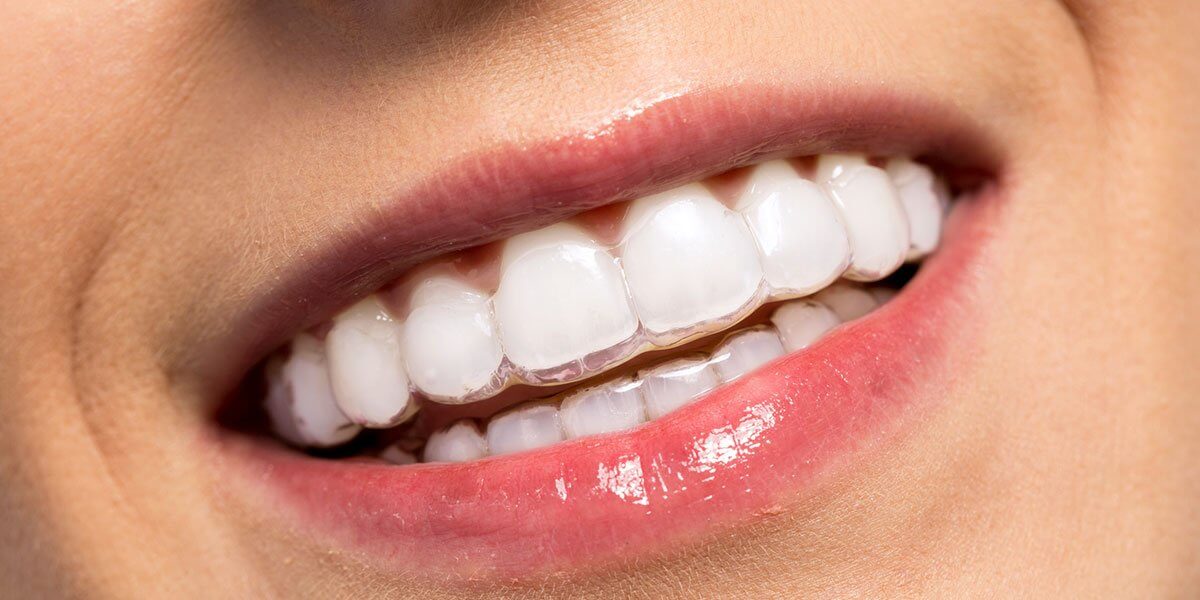 Close-up of clear braces on teeth