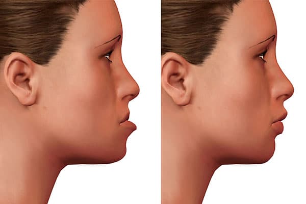 Orthognathic Surgery