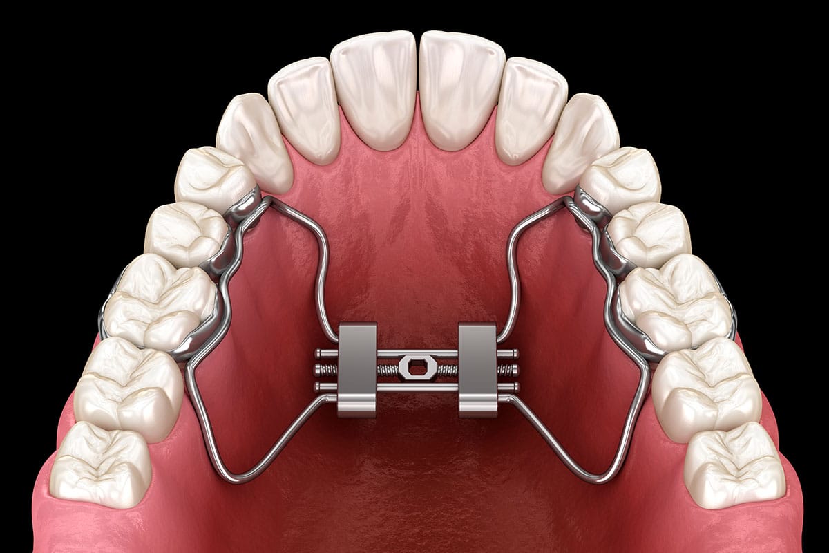 Self-Ligating Braces