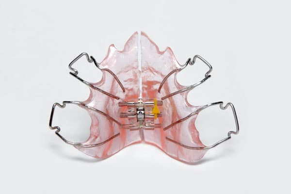 Rapid Palatal Expander